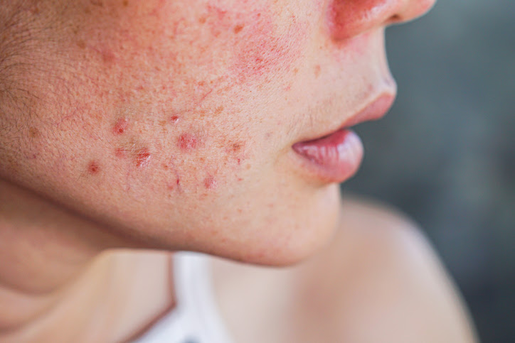 Ang benzoyl peroxide ay mabisa sa paglaban sa mga bacteria na nagdudulot ng acne
