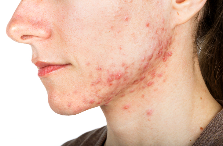  Many may be more familiar with the drug under its brand name, Accutane.  